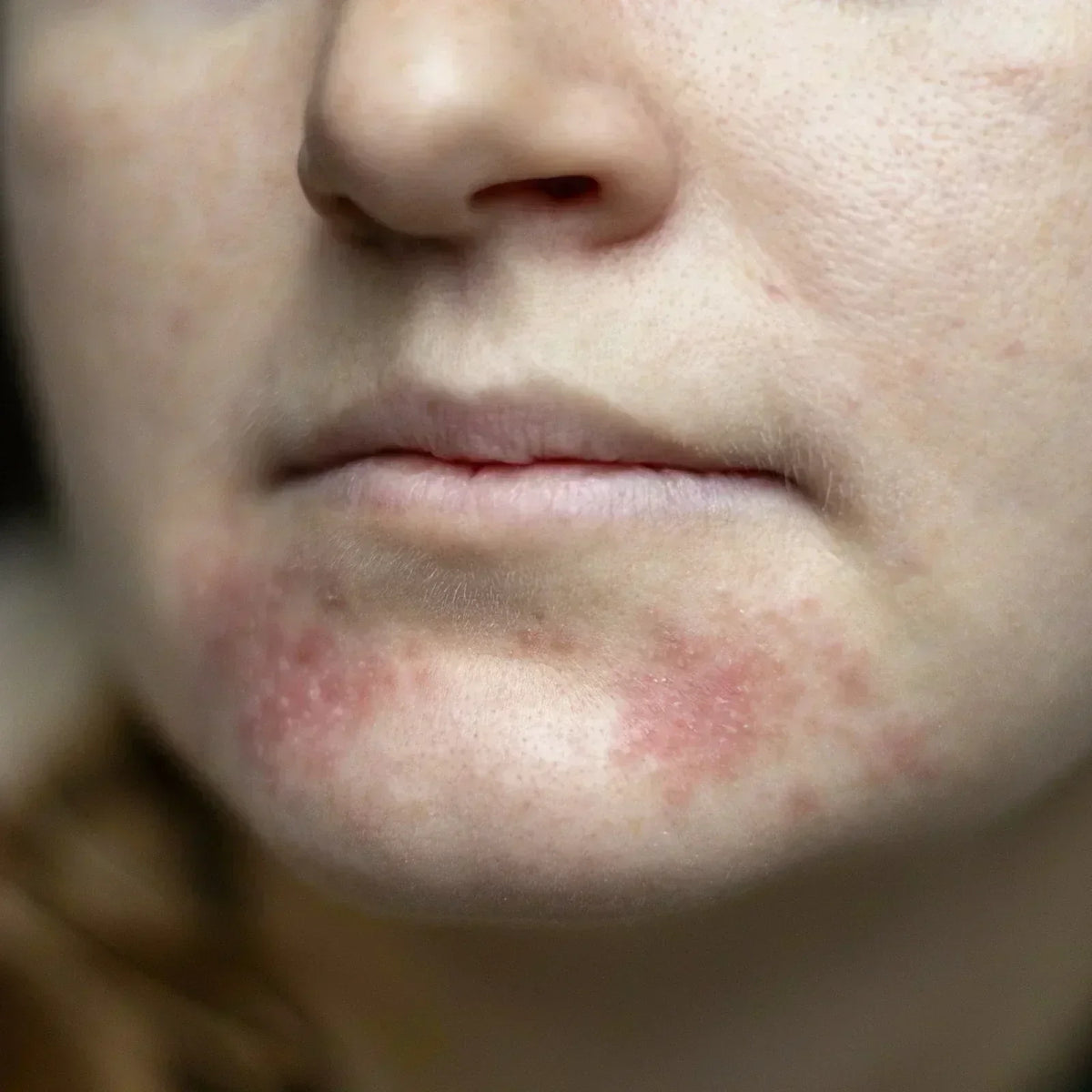 Periorale Dermatitis: Ursachen, Symptome und was bei Mundrose wirklich hilft