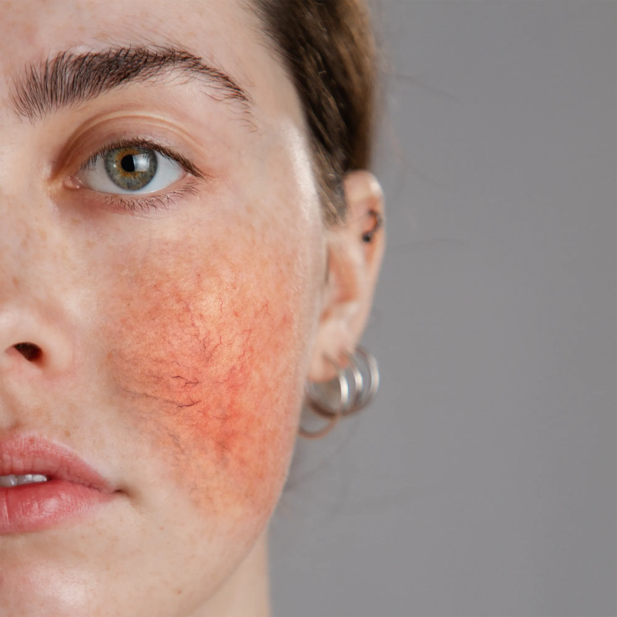 Rosacea Hautbild
