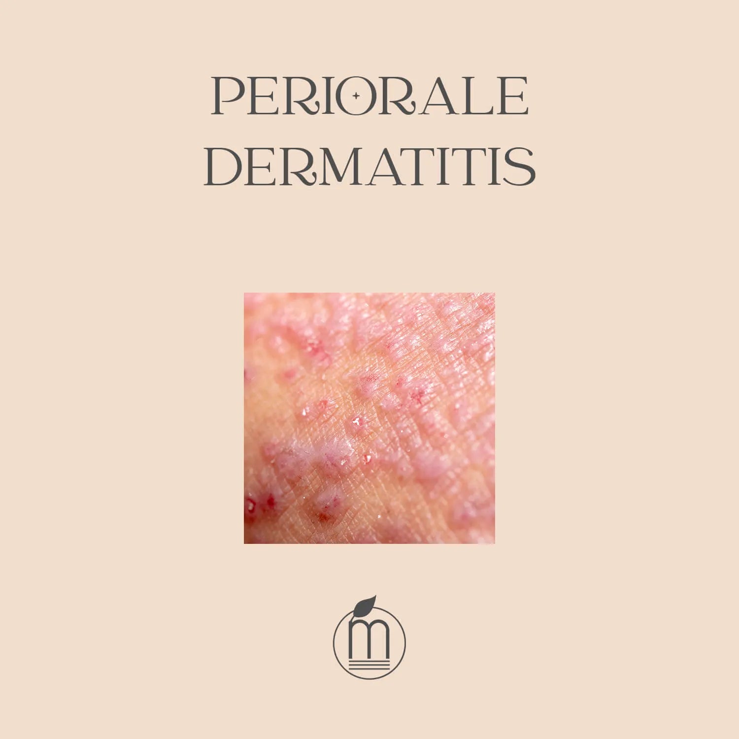 What helps against perioral dermatitis?