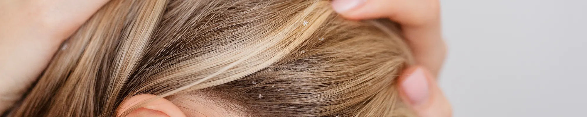 Kopfhautschuppen | Myrto Naturkosmetik