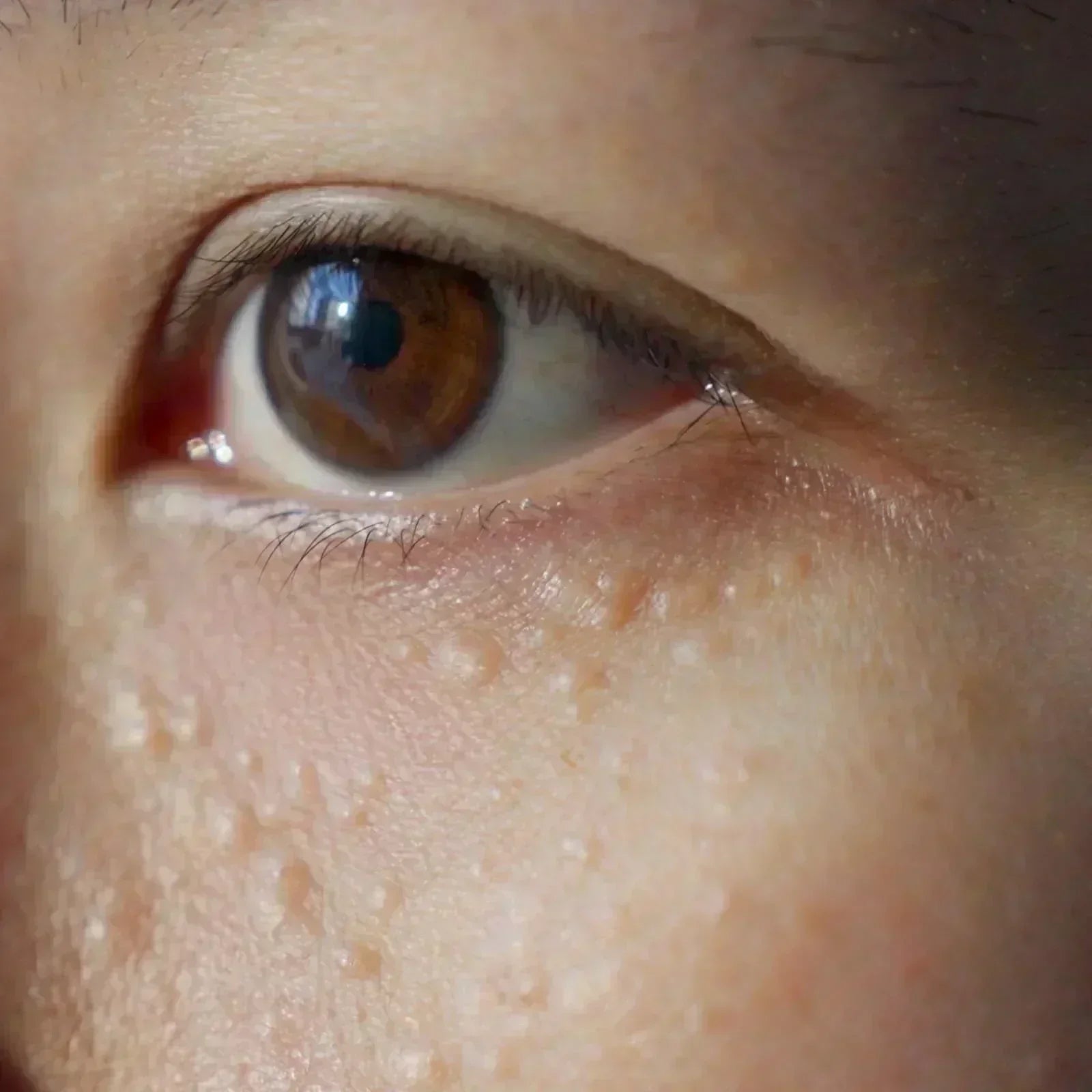 Milien entfernen & vorbeugen – Ursachen und richtige Hautpflege